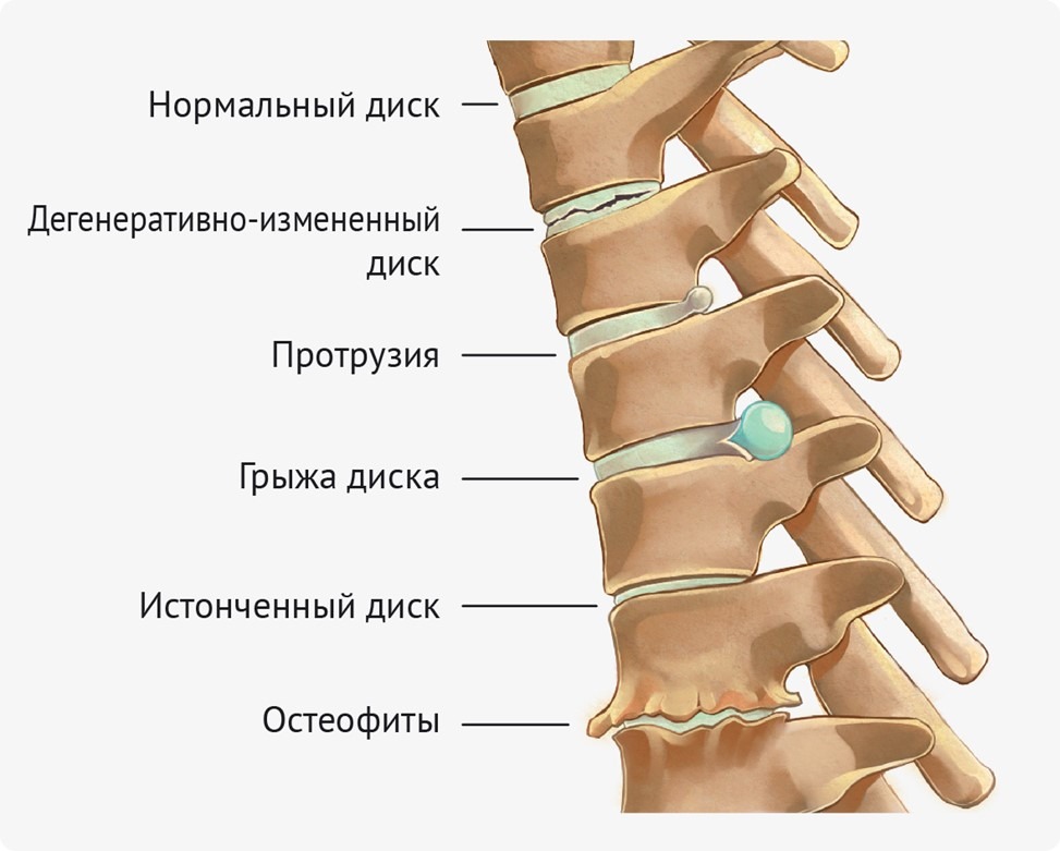 Иллюстрация МРТ позвоночника