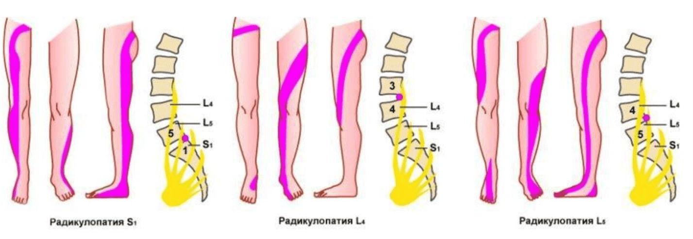Иллюстрация лечебной гимнастики