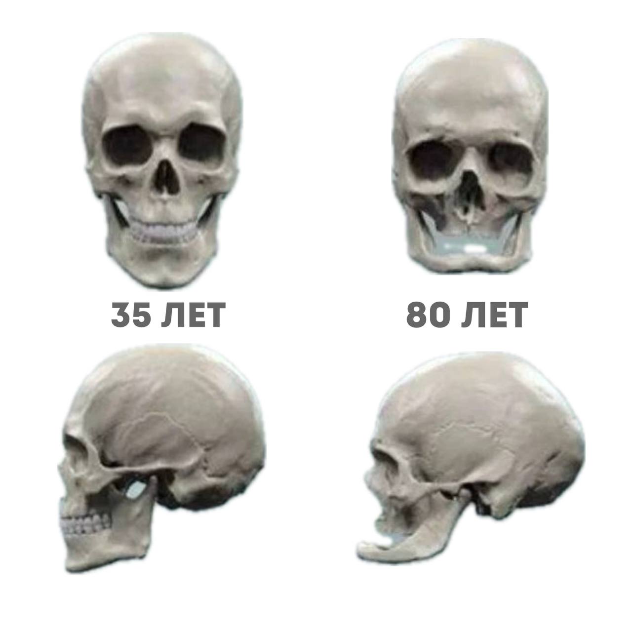 Статья «Сохранить лицо в климаксе?» 4 череп изменения с возрастом