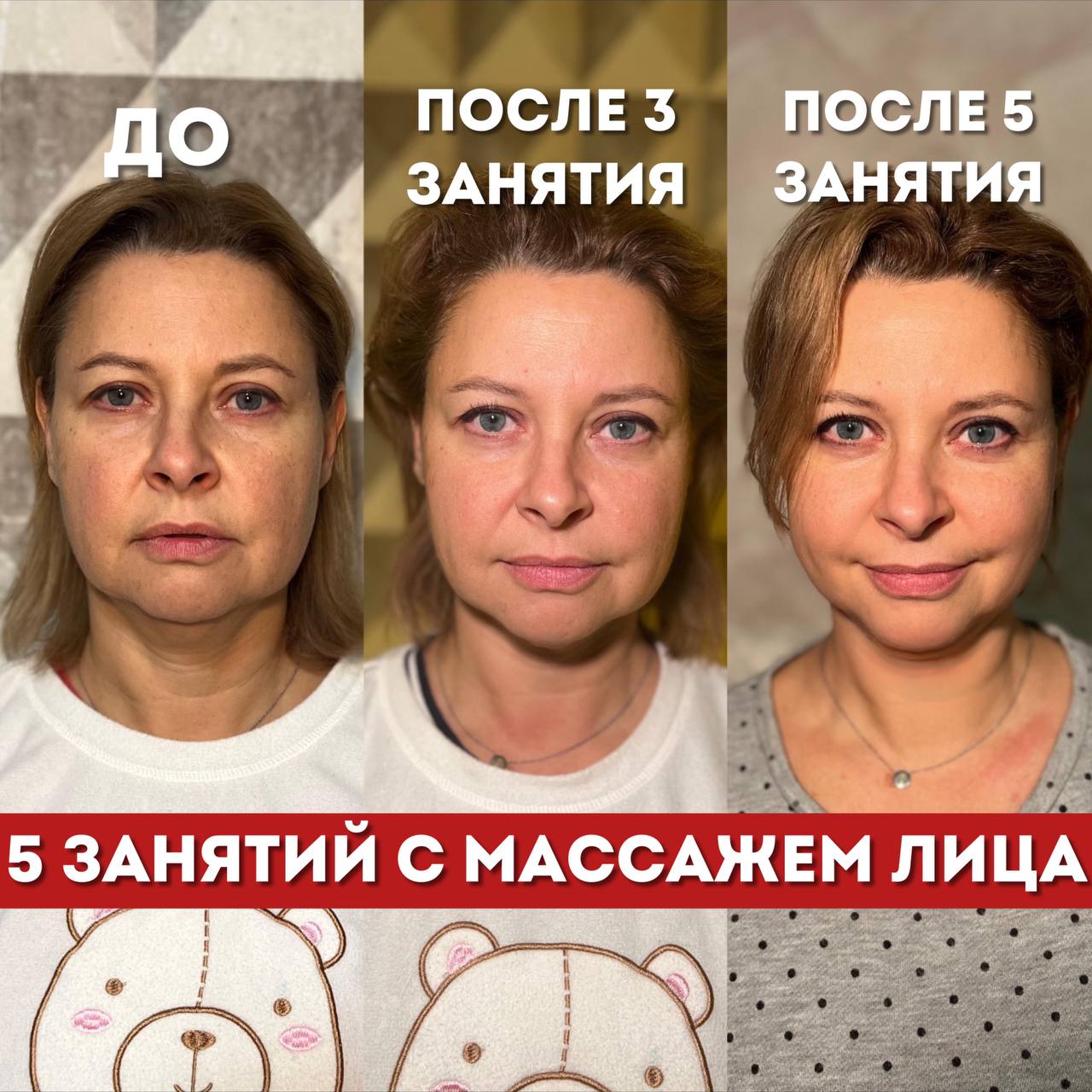 Статья «Сохранить лицо в климаксе?» 6 до после марианна