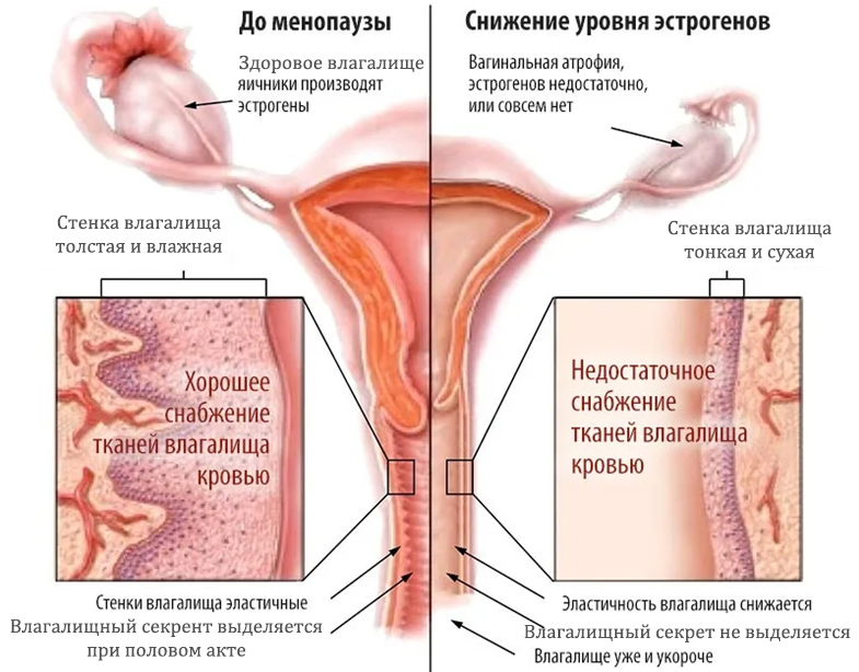 атрофия влагалища