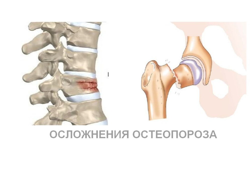 переломы при остеопорозе